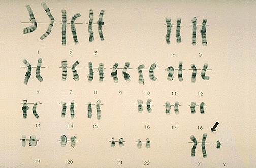 Actual Picture of XXY chromosomes