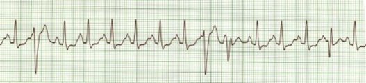 Ekg 12 - Sinus Tachycardia Pvcs