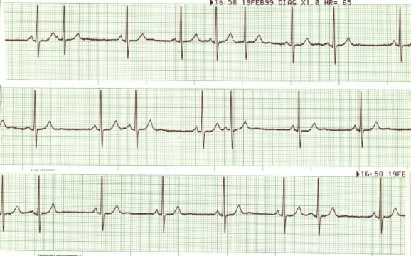 wandering atrial pacemaker rhythm strip
