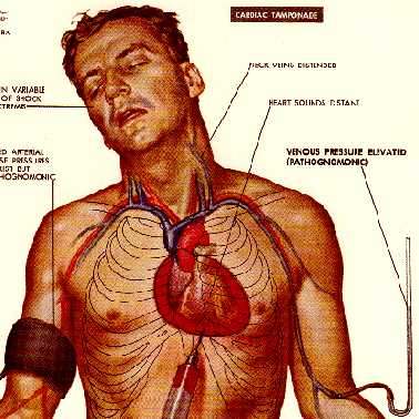 diagrama de taponamiento cardiaco