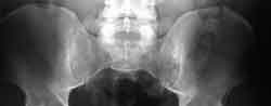 Radiografia caderas
