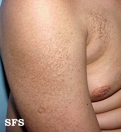 Keratosis Pilaris - The Skin Center: Board-Certified ...