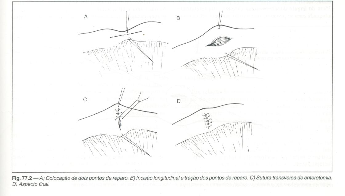 Jejunostomia