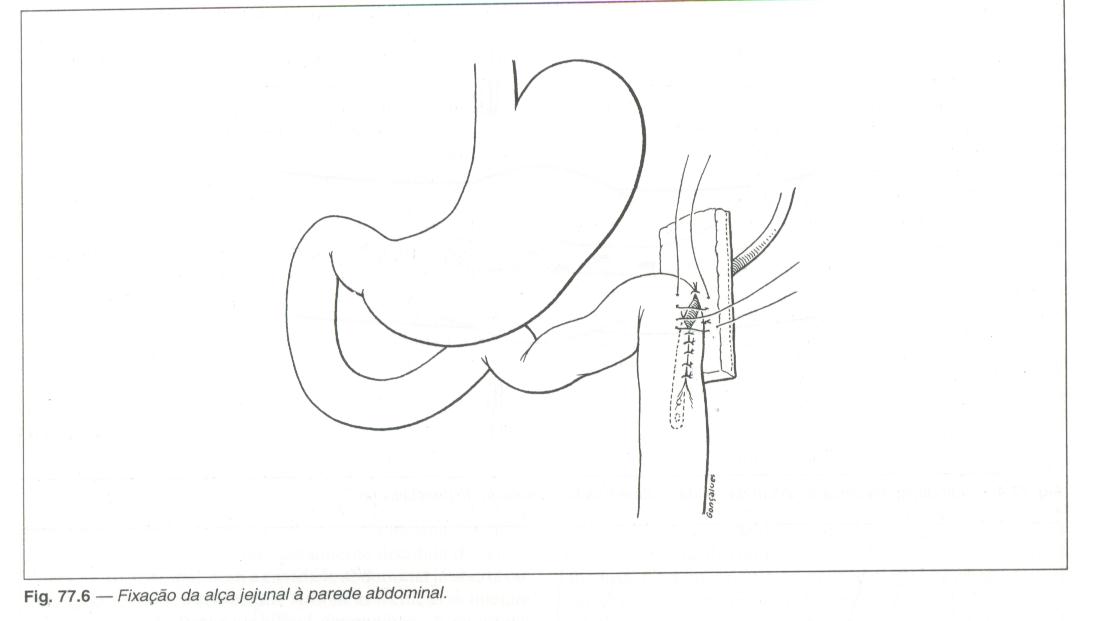 Jejunostomia