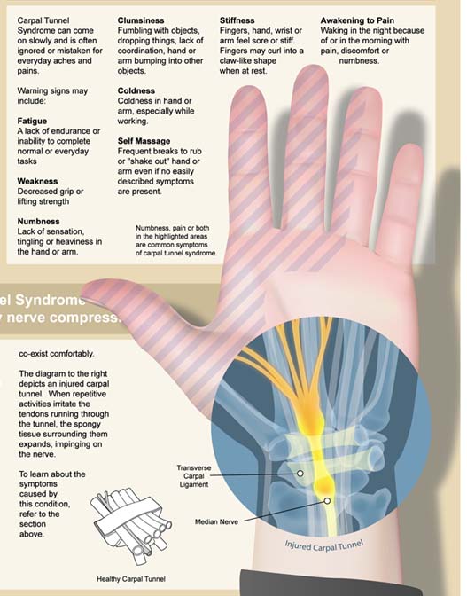 illustrator-carpal-tunnel-syndrome-poster-excerpt-for-print