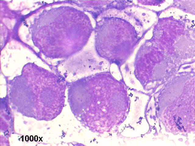 testicular germ cell anaplastic tumor, 1000x M-G-G staining, large anaplastic isolated cells, with huge nucleoli and scarce cytoplasm