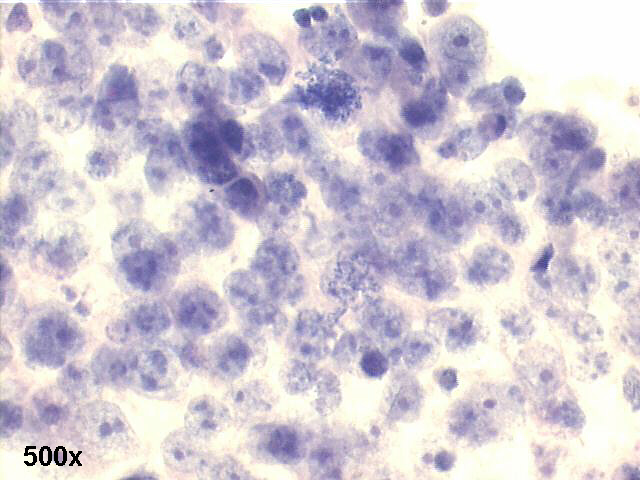 testicular germ cell anaplastic tumor, 500x Pap staining, group of anaplastic cells, with huge nucleoli and scarce cytoplasm