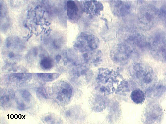 testicular germ cell anaplastic tumor, 1000x Pap staining, group of anaplastic cells, two abnormal mitotic figures