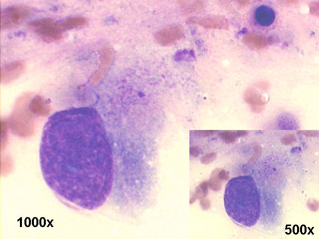 Very large spindle shaped malignant cell, 1,000x and 500x M-G-G staining