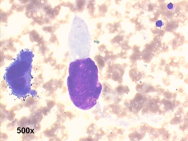 Two spindle malignant cells 500x M-G-G staining
