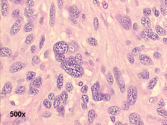 H&E histology ~ many fusiform, sarcomatous cells