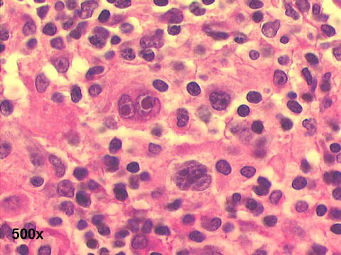 Reed-Sternberg cell 500x H&E staining 