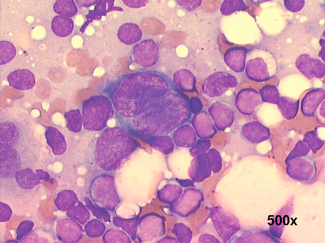 FNA left cervical mass, large binucleated blast 500x M-G-G staining