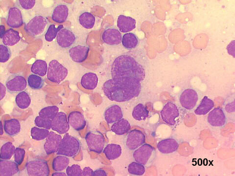 FNA left cervical mass, Reed-Sternberg cell 500x M-G-G 