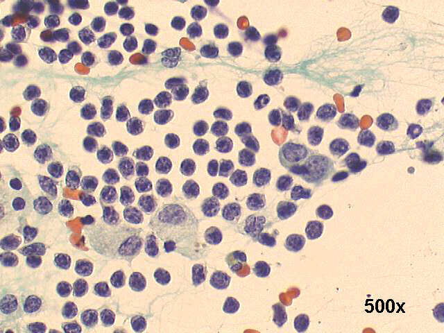 500x Papanicolaou staining, predominance of lymphocytes