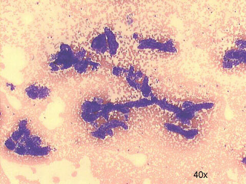 Numerous papillary fragments, absence of colloid 40x M-G-G staining