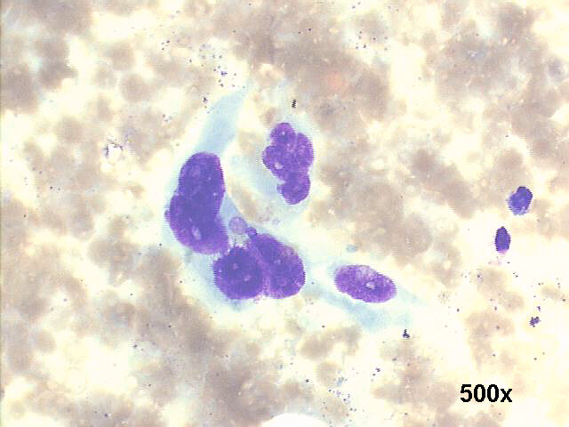 Several spindle malignant cells 500x M-G-G staining