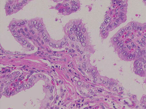 Notice many 'empty nuclei' 200x H&E staining
