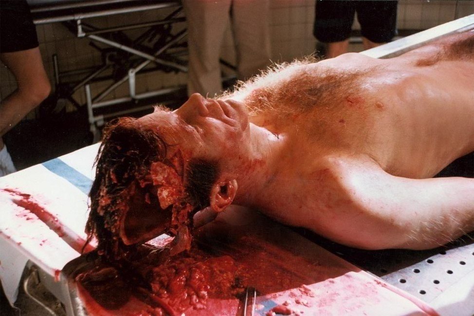 Jfk Pictures Autopsy