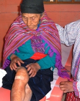 another patient inspects her knee after getting fluid drained out