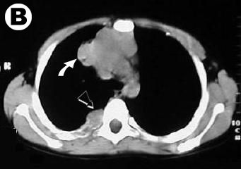 Corte tomografico: tumor mediastino y lesion costal posterior