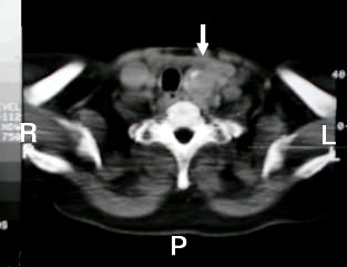tomografia cervical bocio intratoracico