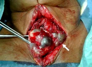 Cervicotomia transversa Tiroides intratoracica cervical