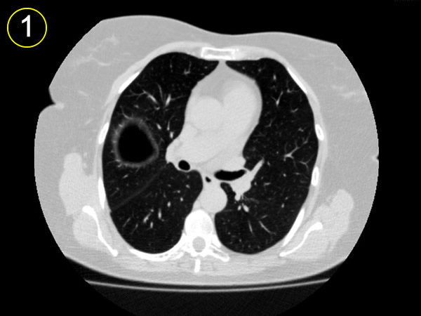 Corte tomografico 1, a nivel sub carinal