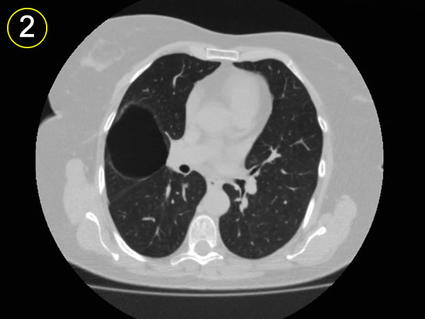 Corte tomografico 2, arbol bronquial 