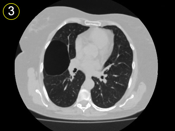 Corte tomografico 3, arbol bronquial distal