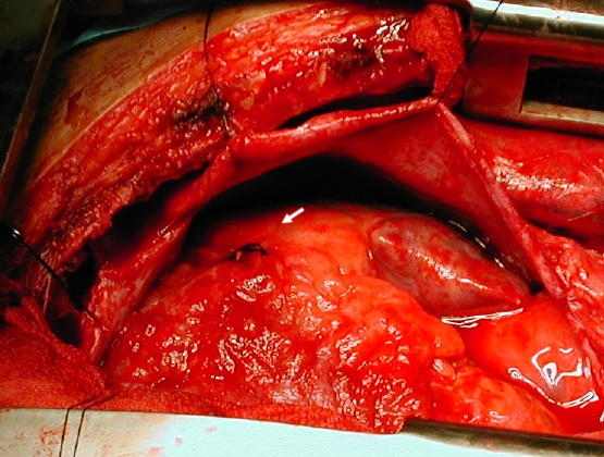 La sutura en la pared ventricular derecha