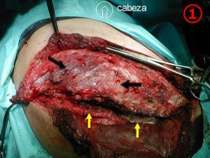 apertura cavidad y seccion del tumor costal