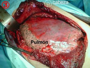 Pulmon subyacente al tumor costal
