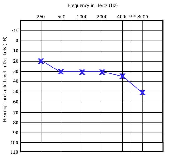How to Read an Audiogram The Basics