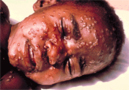 Varola humana (smallpox) erradicada com vacina
