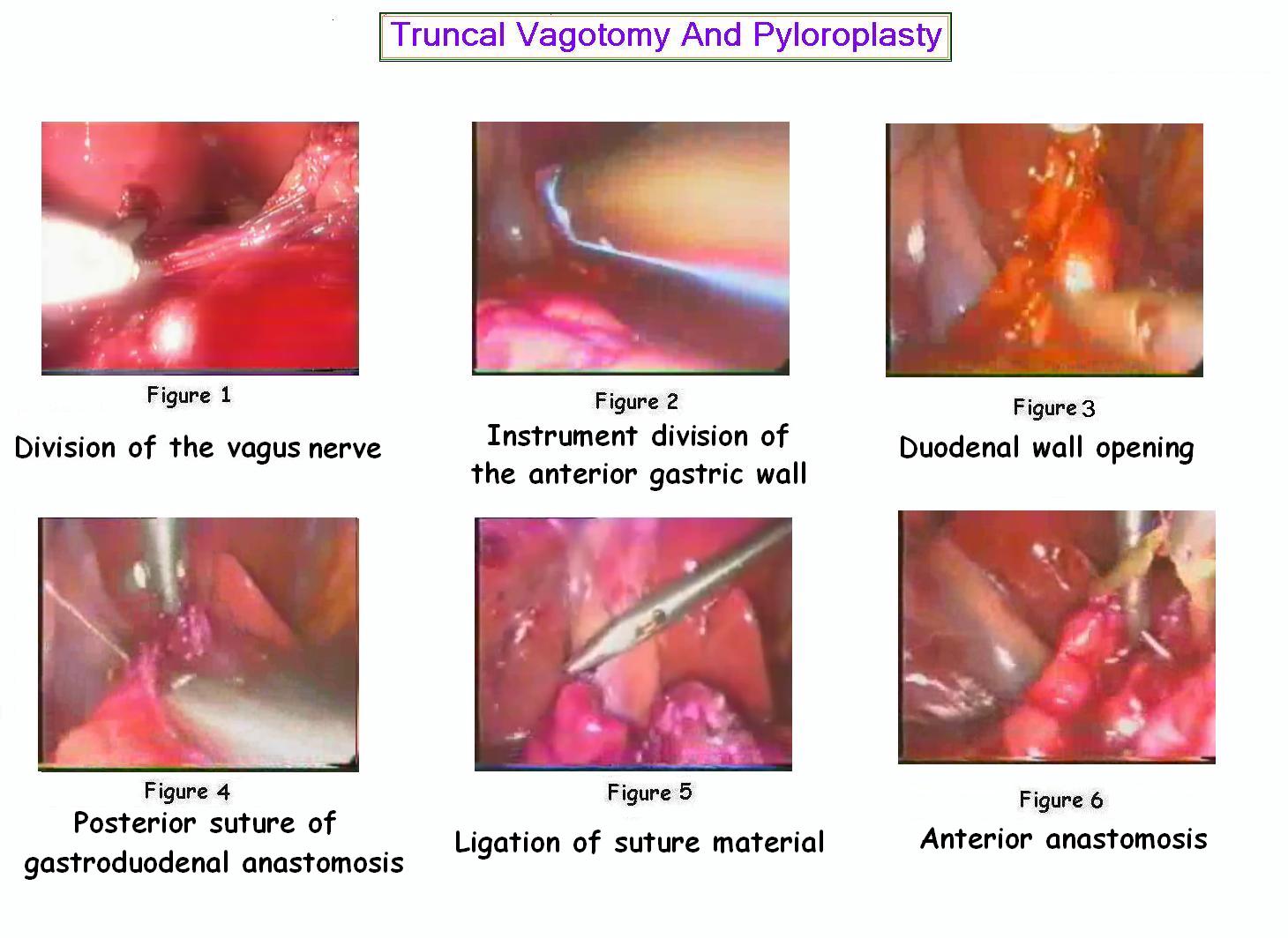 vagotomy and pyloroplasty