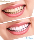 whitening teeth products home