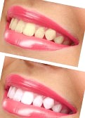 whitening for sensitive teeth at home