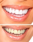 make teeth white at home for free