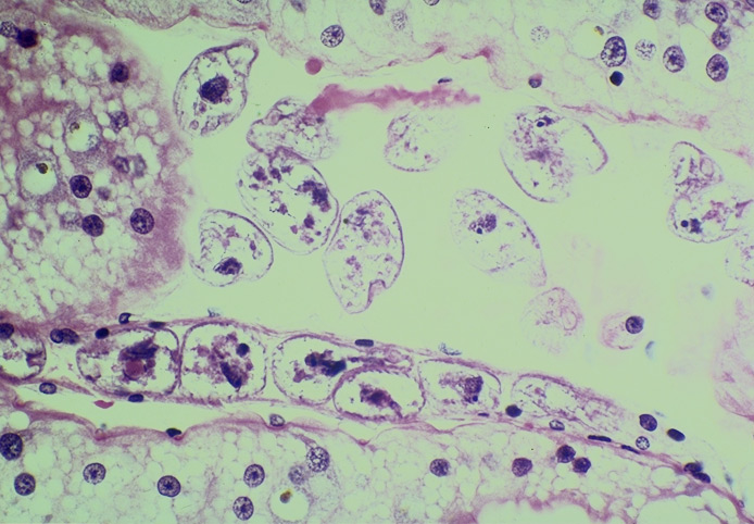 Light micrograph of Tetrahymena pyriformis infection of hepatopancreas ...