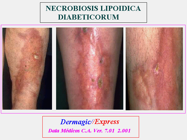 Necrobiosis Lipoidica Diabeticorum