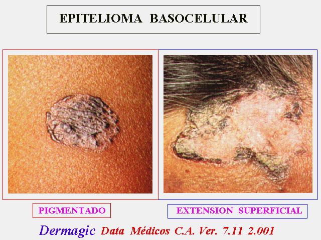 Epiteloma baso celular pigmentado y de extension superficial