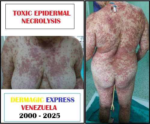 Necrólisis Epidérmica toxica o síndrome de Lyell