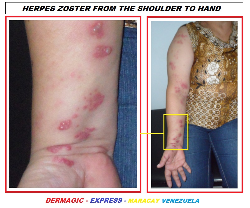 Herpes Zoster or shingles on rigth arm