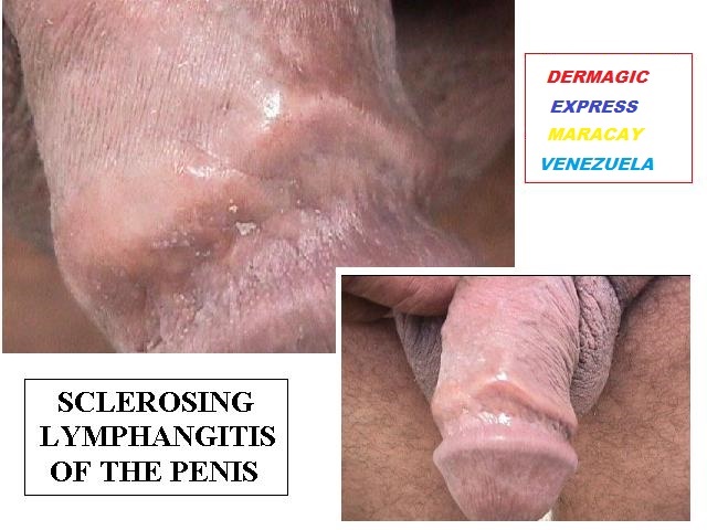 Sclerosis limphamgitis of the penis 