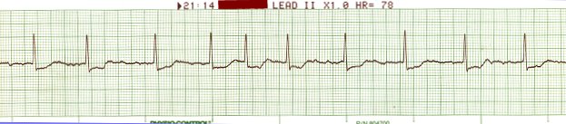 EKG 99 - Atrial Fibrillation