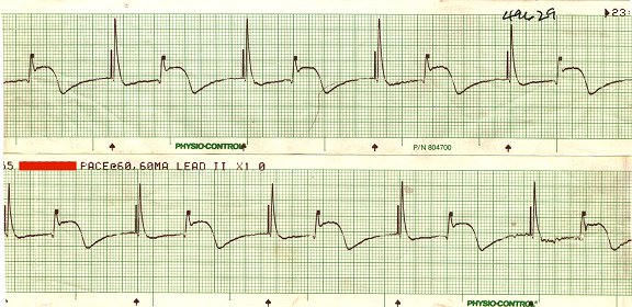 EKG - Underlyng Bradycardia with External Pacing