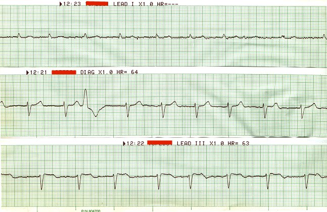 EKG 112 - Atrial Fibrillation with Ashman's Phenomenon