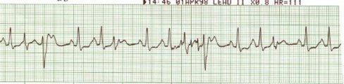 EKG 15 - Sinus Rhythm/PVCs