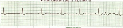 EKG 17 - CHB?